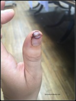 Thumb tip cut on the mend