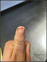 Thumb tip fell off